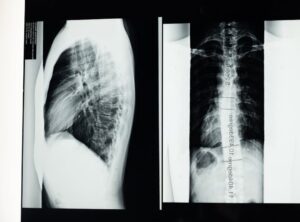 Why Gerenaldoposis Disease Is Bad